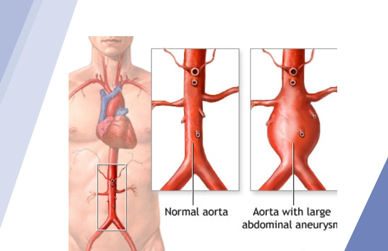 varicose_veins_content_image